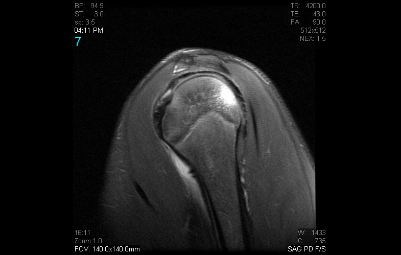 Figure 6 for case anterior shoulder dislocation